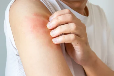 skin infections