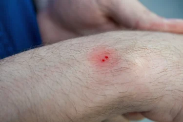 Snake bite