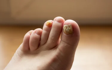 fungal nail infections