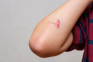 wound healing 