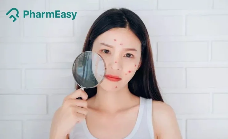 Natural Masks for Acne