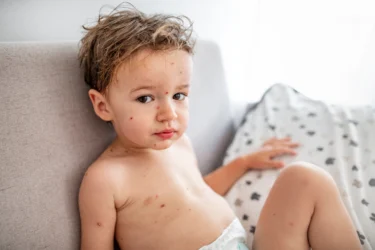 chickenpox