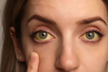 jaundice
