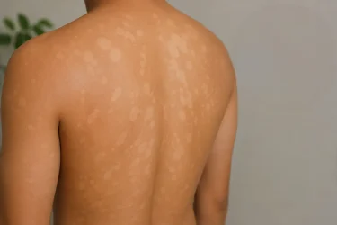Tinea Versicolor