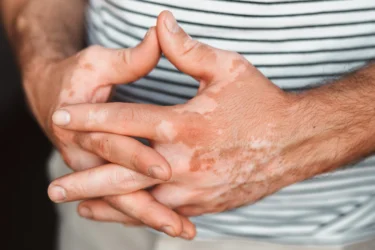 Vitiligo