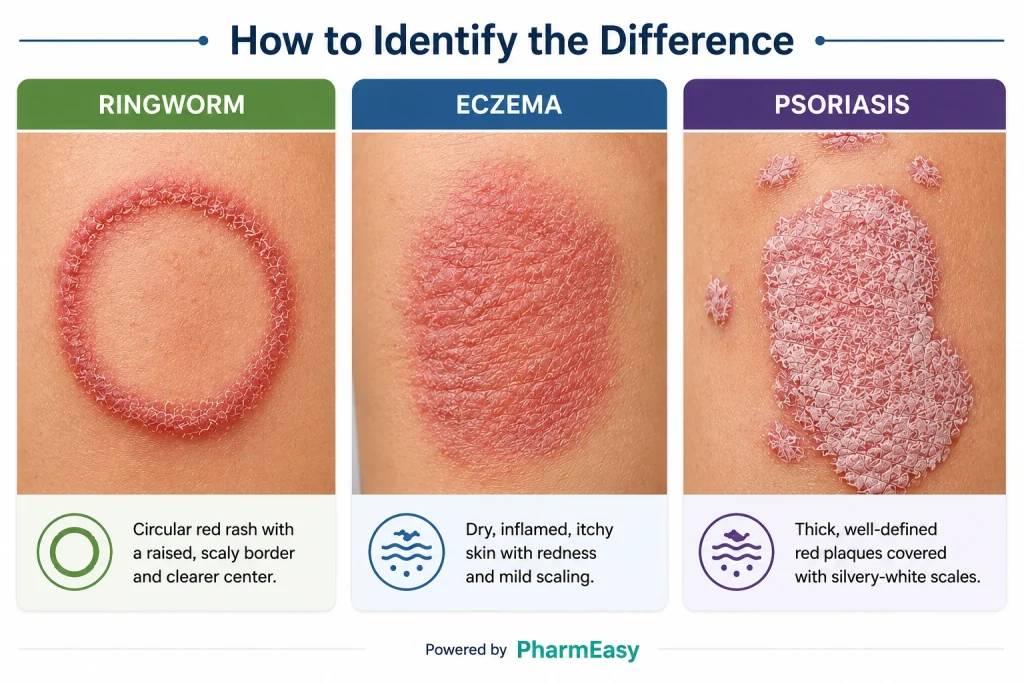 ringworm vs eczema vs psoriasis 