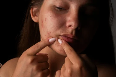 avoid scratching or poping the acne