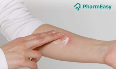 mosquito bites