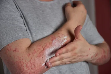 Leishmaniasis