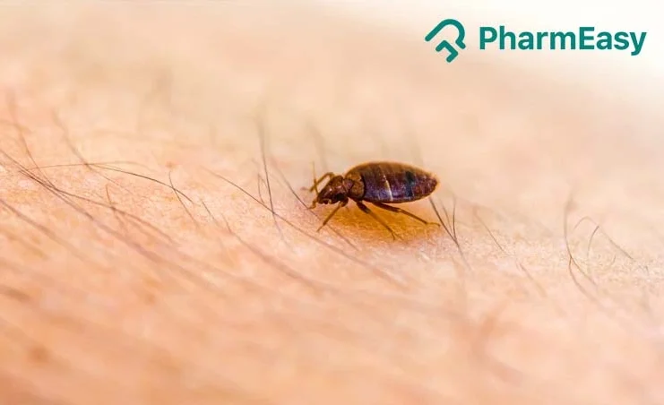 bed bug bites