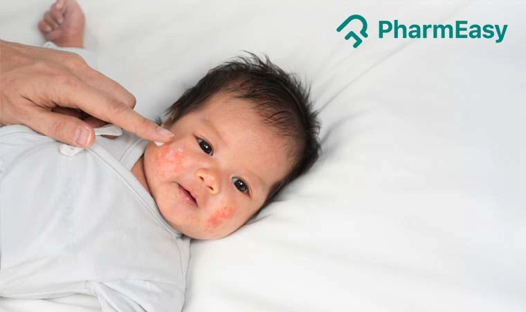 Baby Rash: Types, Treatment, Home Remedies & More | PharmEasy
