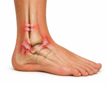complex ankle sprain