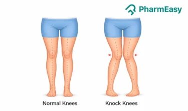 knock knees