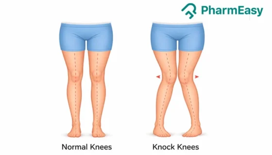 knock knees