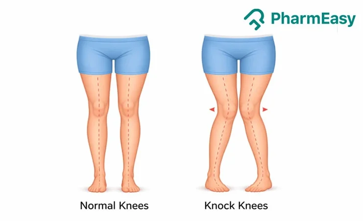 knock knees