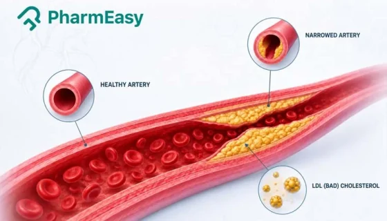 High LDL (bad) cholesterol