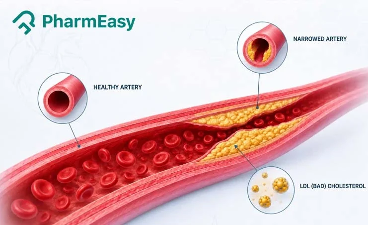 High LDL (bad) cholesterol