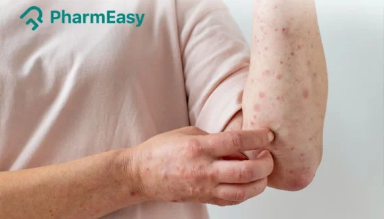 Typhoid Fever Rash