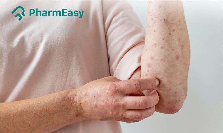Typhoid Fever Rash: What is It, Symptoms, Causes & Treatment | PharmEasy