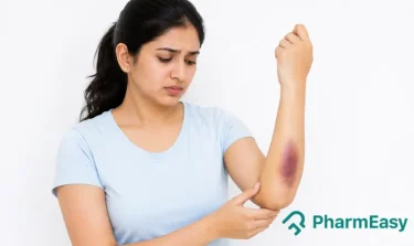 easy bruising