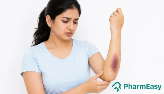 easy bruising