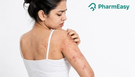 Dermatitis Herpetiformis