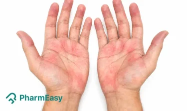 Palmar Erythema