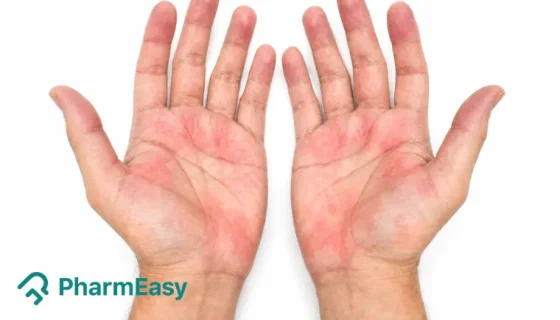 Palmar Erythema