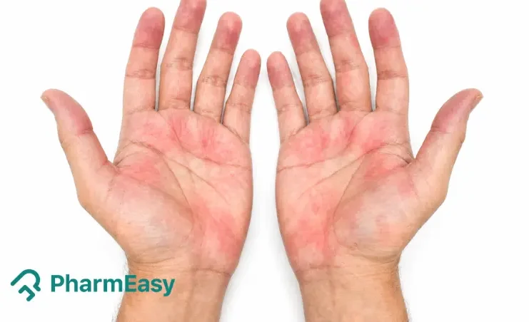 Palmar Erythema