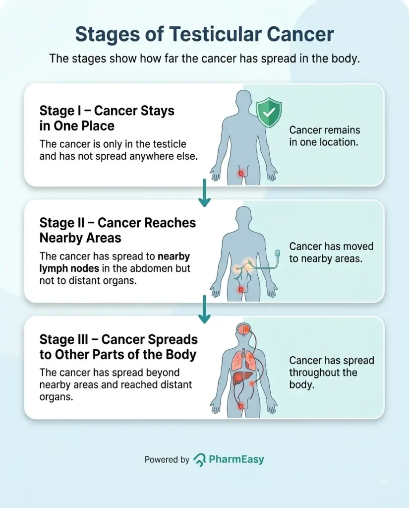 Stages of Testicular Cancer