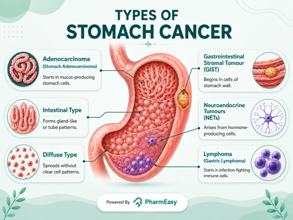Types of Stomach Cancer