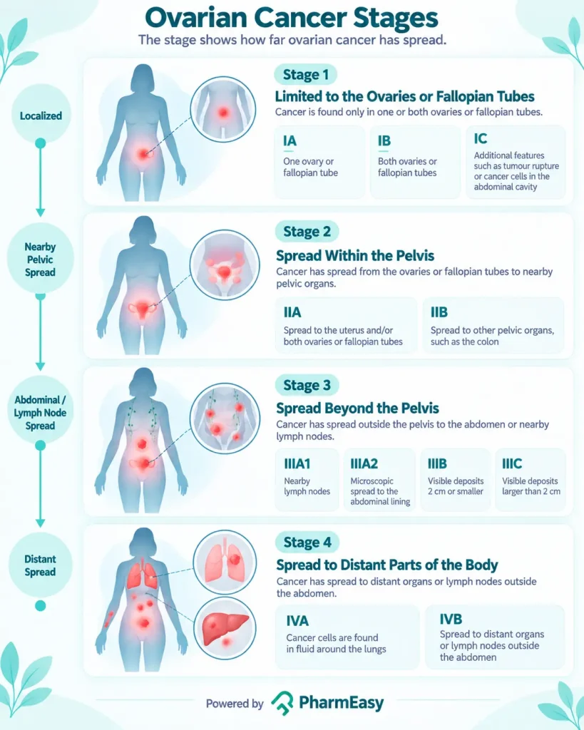 Ovarian Cancer Stages 