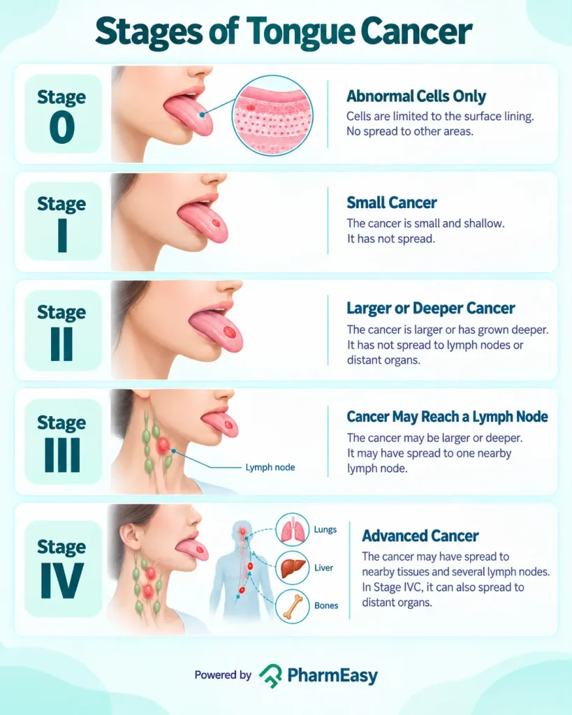 Stages of Tongue Cancer
