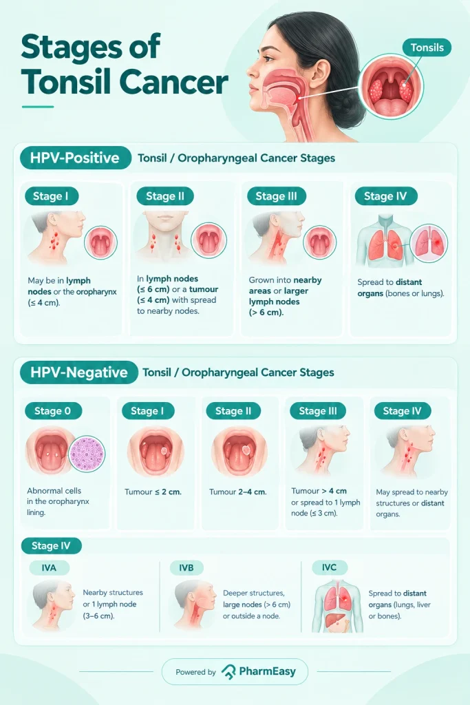 Stages of Tonsil Cancer