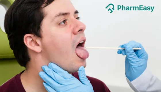 Tongue Cancer