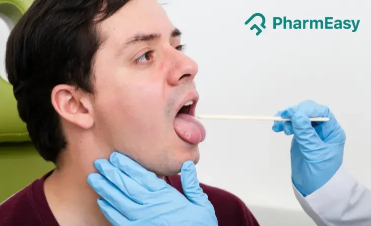 Tongue Cancer