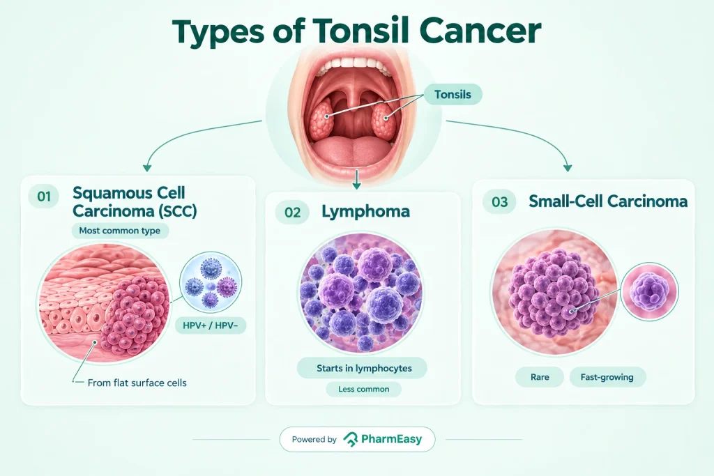 Types of Tonsil Cancer