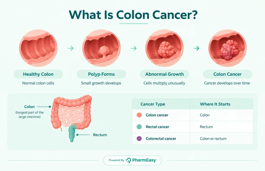 What Is Colon Cancer?
