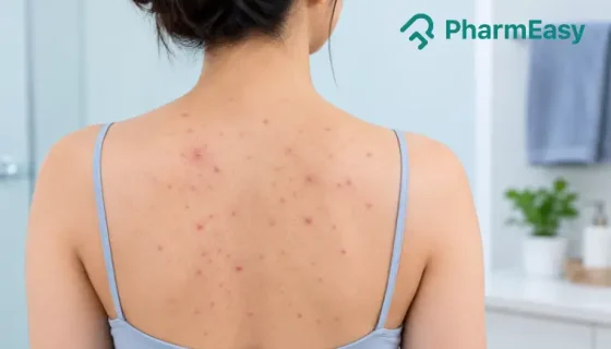 back acne