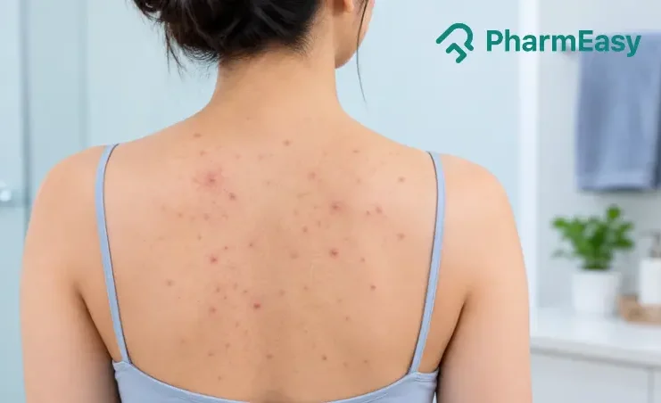 back acne