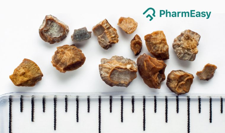 Everything You Need to Know About Kidney Stones Removal  