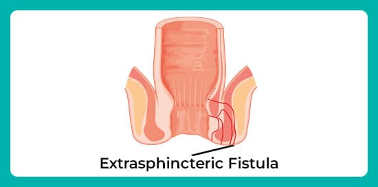 Extrasphincteric-fistula.jpg