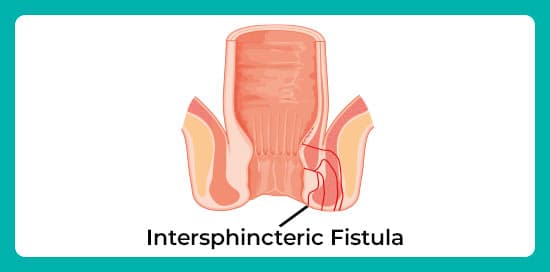 Intersphincteric-fistula.jpg