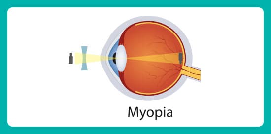 Myopia.jpg