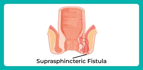 Suprasphincteric-fistula.jpg