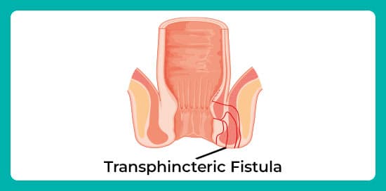 Transphincteric-fistula.jpg