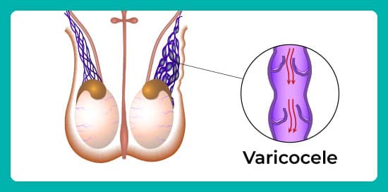 Varicocele-can-only-be-seen-in-certain-positions (1).jpg