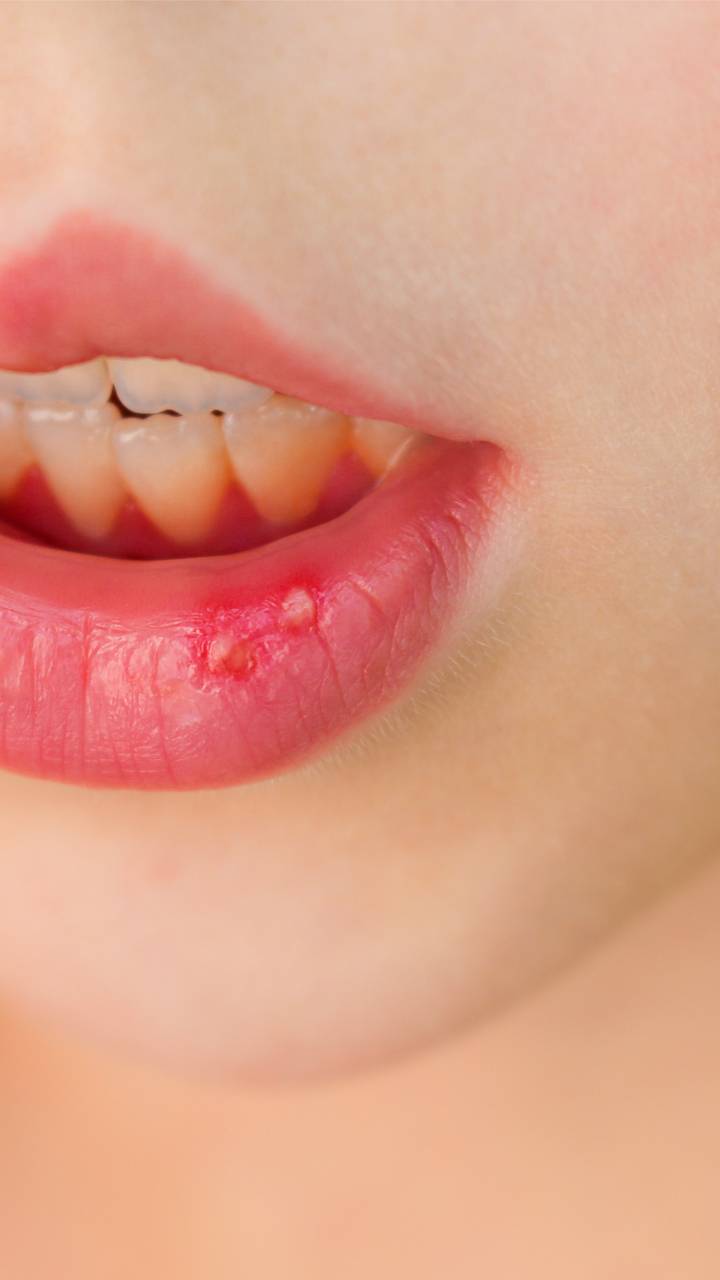 best-home-remedies-for-mouth-ulcers