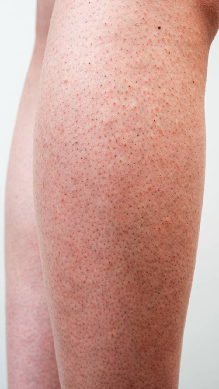 How To Get Rid of Strawberry Legs?